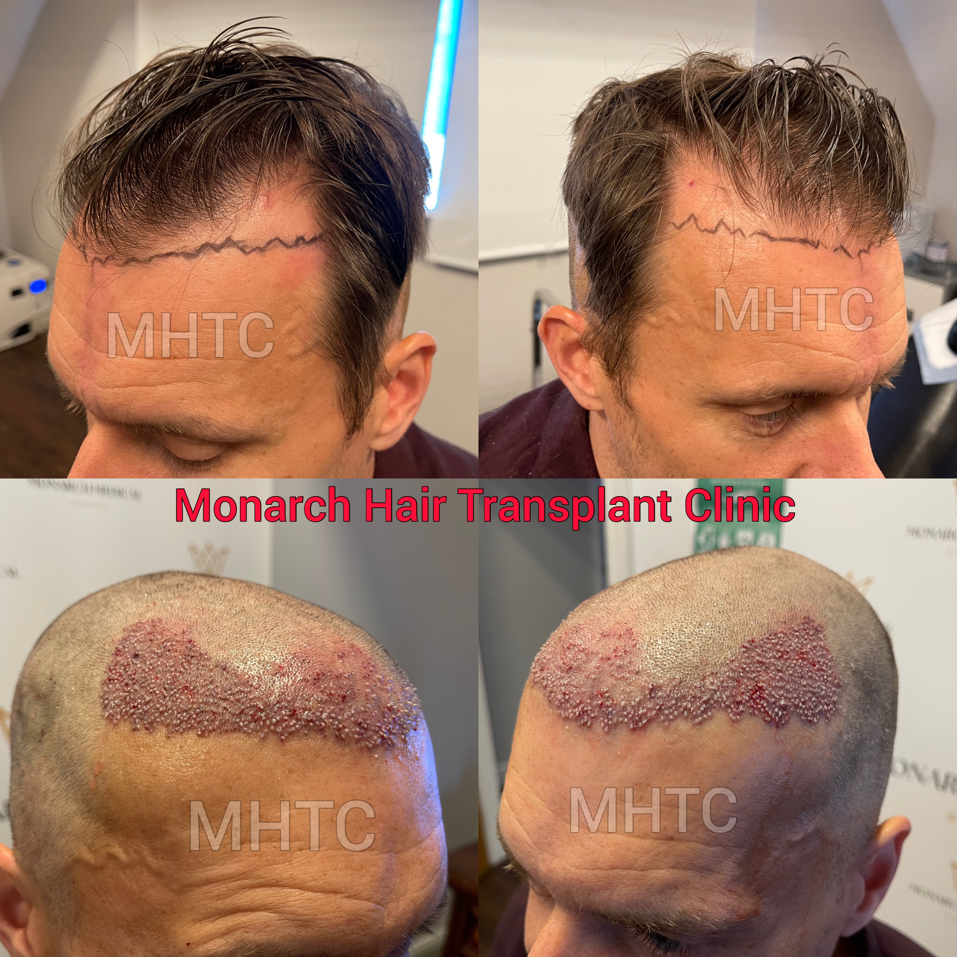 6-month hair transplant results